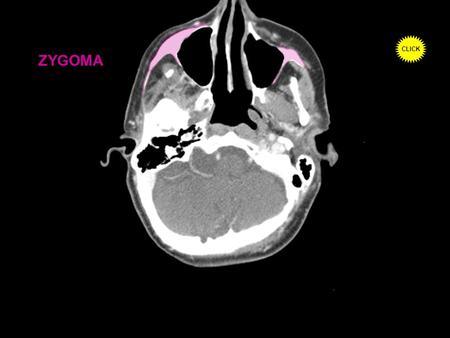 ZYGOMA CLICK. MAXILLARY SINUSES NASAL SEPTUM CLICK.