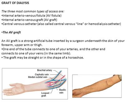 GRAFT OF DIALYSIS The three most common types of access are: