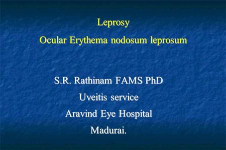 Leprosy Ocular Erythema nodosum leprosum S.R. Rathinam FAMS PhD Uveitis service Aravind Eye Hospital Madurai.