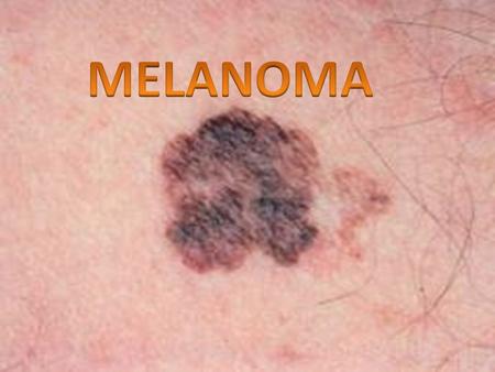 Melanoma is a cancerous cell which is caused from the sun. It can quickly spread from the surface of the skin to other parts of the body.