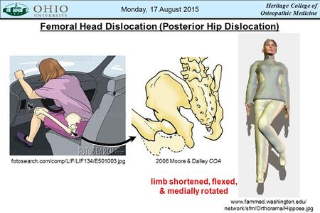 Femoral Head Dislocation (Posterior Hip Dislocation) 2006 Moore & Dalley COA fotosearch.com/comp/LIF/LIF134/E501003.jpg www.fammed.washington.edu/ network/sfm/Orthorama/Hippose.jpg.