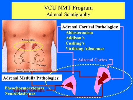 VCU NMT Program Adrenal Scintigraphy Aldosteronism Addison’s Cushing’s Virilizing Adenomas Pheochormocytomas Neuroblastomas Adrenal Cortical Pathologies: