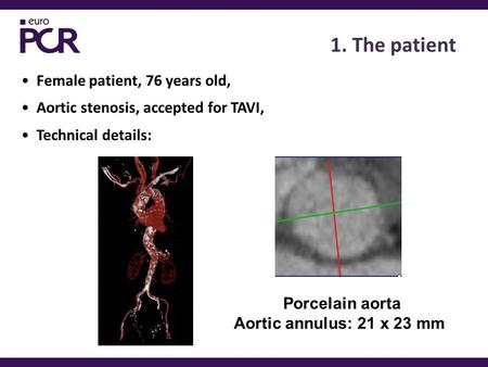 1. The patient Female patient, 76 years old, Aortic stenosis, accepted for TAVI, Technical details: Porcelain aorta Aortic annulus: 21 x 23 mm.