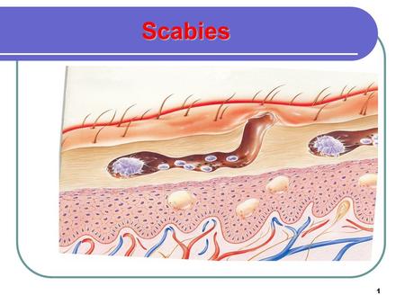 Scabies.