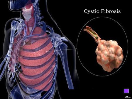 Cystic Fibrosis BD 2011.