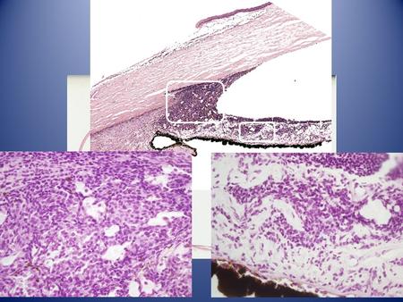 Diagnosis – Malignant melanoma of anterior ciliary body and iris root, spindle cell type with invasion of Schlemm’s canal and collector channels –