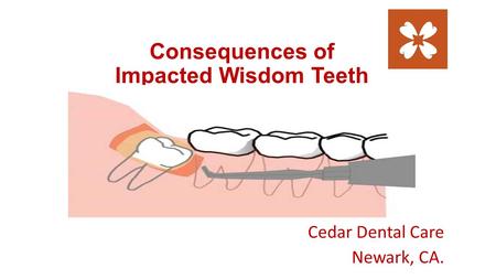 Consequences of Impacted Wisdom Teeth Cedar Dental Care Newark, CA.