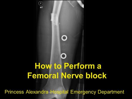 How to Perform a Femoral Nerve block