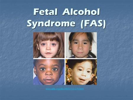 Fetal Alcohol Syndrome (FAS) www.aafp.org/afp/20050715/279.html.