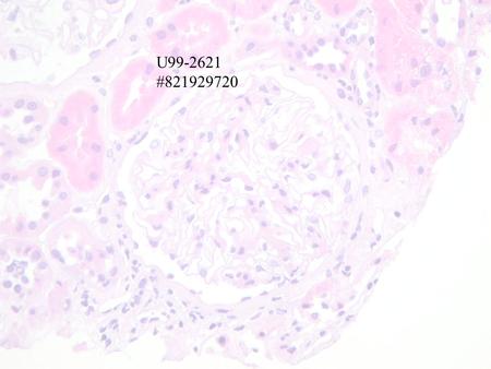 U99-2621 #821929720. IgG- strong coarsely granular capillary loop staining,mild to moderate granular peritubular staining IgA- moderate mesangial staining.