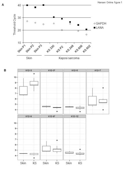 Hansen Online figure 1 GAPDH LANA 10 20 30 40 Skin P1Skin P2Skin P3 KS 330 KS P2 KS 248KS 606 KS 602 Threshold Cycle SkinKaposi sarcoma A B SkinKSSkinKSSkinKS.