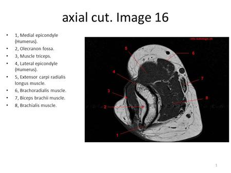 axial cut. Image 16 1, Medial epicondyle (Humerus).