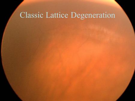 Classic Lattice Degeneration. Perivascular Lattice.