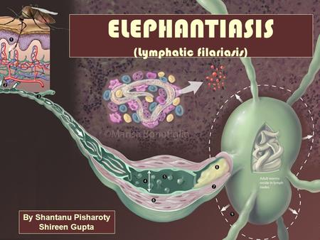 (Lymphatic filariasis)