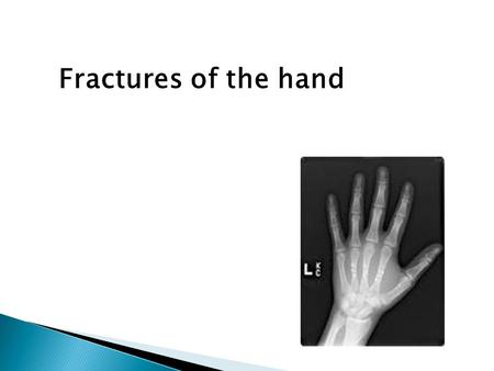 Fractures of the hand.