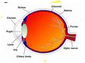 Developmental cataract Present at birth or after birth 25% have a hereditary predisposition Causes : intrauterine infections [TORCHES] : prematurity,