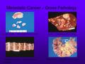 Metastatic Cancer – Gross Pathology Lymph node - metastasis from breastLiver – metastasis from lung Vertebral column – metastasis from prostate Mesentery.