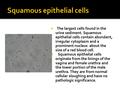  The largest cells found in the urine sediment. Squamous epithelial cells contain abundant, irregular cytoplasm and a prominent nucleus about the size.