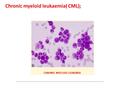 Chronic myeloid leukaemia( CML);. CML is an excessive proliferation with fairly normal maturation. The disease occurs mainly between 30 and 80 years with.