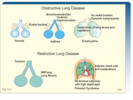 Definition of asthma Asthma is a heterogeneous disease, usually characterized by chronic airway inflammation. It is defined by the history of respiratory.