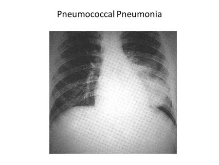 Pneumococcal Pneumonia. Symptoms & signs of pneumococcal pneumonia Sudden onsets of chills, fever 40°C and malaise Cough, tachypnea, dyspnea and chest.