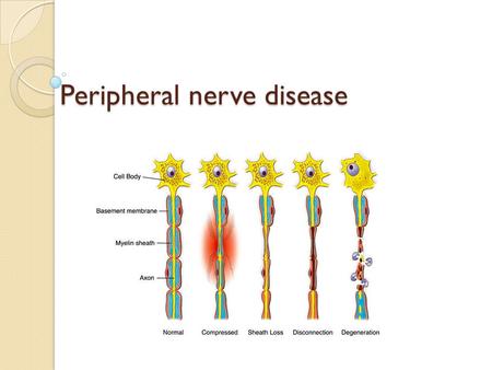 Peripheral nerve disease Peripheral nerve disease.