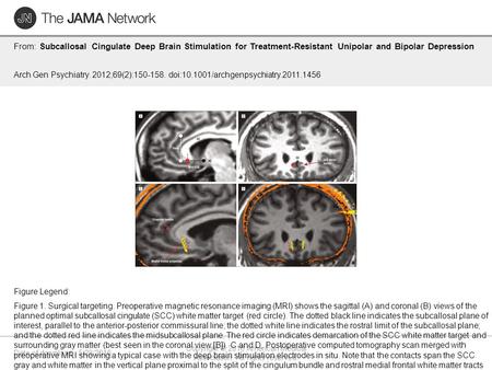 Date of download: 5/28/2016 Copyright © 2016 American Medical Association. All rights reserved. From: Subcallosal Cingulate Deep Brain Stimulation for.