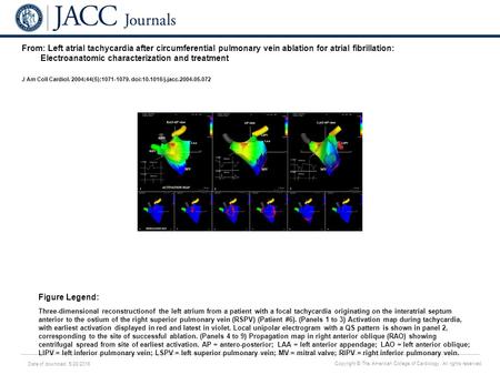 Date of download: 5/28/2016 Copyright © The American College of Cardiology. All rights reserved. From: Left atrial tachycardia after circumferential pulmonary.