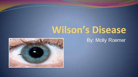 Wilson’s Disease By: Molly Roemer.