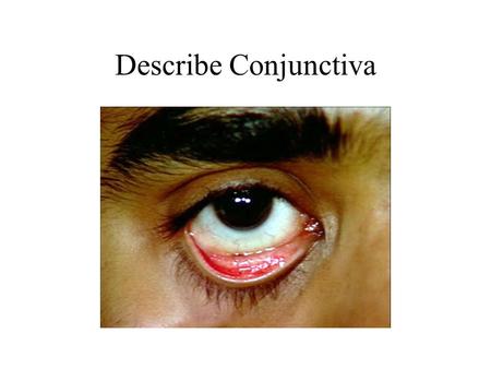 Describe Conjunctiva. Conjunctiva is translucent and clear. The pink color of palpebral conjunctiva is due to underlying vascular bed. White Sclera is.