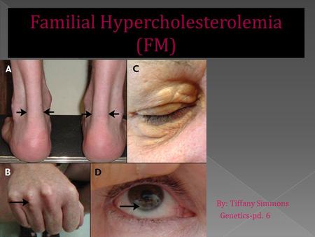  By: Tiffany Simmons  Genetics-pd. 6 Familial Hypercholesterolemia (FM)