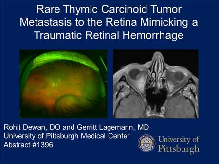 Rare Thymic Carcinoid Tumor Metastasis to the Retina Mimicking a Traumatic Retinal Hemorrhage Rohit Dewan, DO and Gerritt Lagemann, MD University of Pittsburgh.