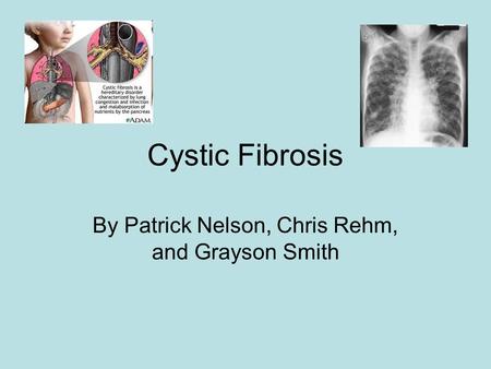 By Patrick Nelson, Chris Rehm, and Grayson Smith Cystic Fibrosis.