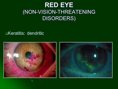 RED EYE (NON-VISION-THREATENING DISORDERS)  Keratitis: dendritic.