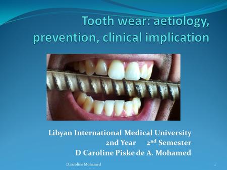 Tooth wear: aetiology, prevention, clinical implication