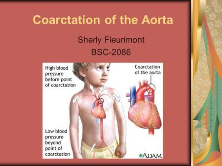 Coarctation of the Aorta Sherly Fleurimont BSC-2086.