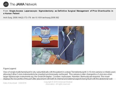 Date of download: 5/28/2016 Copyright © 2016 American Medical Association. All rights reserved. From: Single-Access Laparoscopic Sigmoidectomy as Definitive.