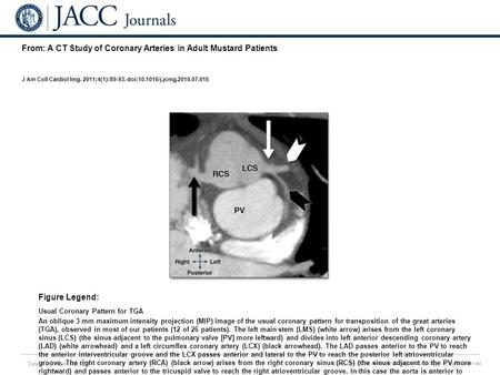 Date of download: 5/28/2016 Copyright © The American College of Cardiology. All rights reserved. From: A CT Study of Coronary Arteries in Adult Mustard.