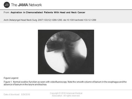 Date of download: 5/29/2016 Copyright © 2016 American Medical Association. All rights reserved. From: Aspiration in Chemoradiated Patients With Head and.