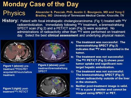 Monday Case of the Day A) The treatment was successful: The bremsstrahlung SPECT (Fig 2) indicates that 90 Y was deposited in the tumor. B) The treatment.