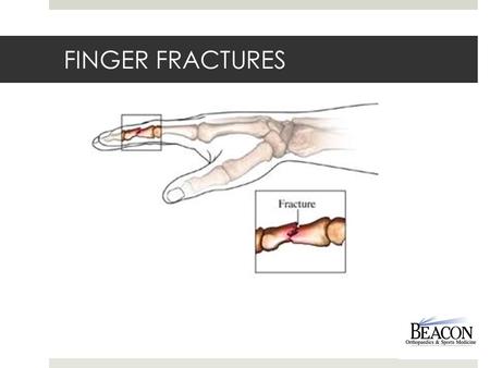 FINGER FRACTURES. What happened??  One of the bones in your finger has been broken, see the bones of the hand and fingers to the left.  Following trauma.