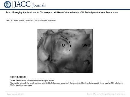 Date of download: 5/29/2016 Copyright © The American College of Cardiology. All rights reserved. From: Emerging Applications for Transseptal Left Heart.