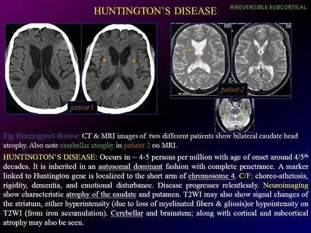 HUNTINGTON’S DISEASE patient 2 patient 1