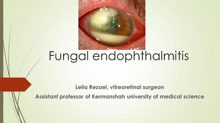 Fungal endophthalmitis