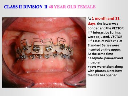 CLASS II DIVISION II 48 YEAR OLD FEMALE At 1 month and 11 days the lower was bonded and the VECTOR III® Interactive Springs were adjusted. VECTOR III®