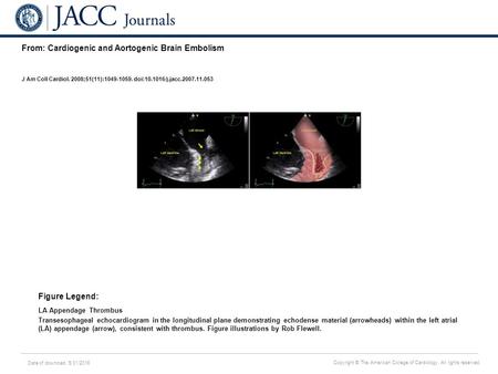 Date of download: 5/31/2016 Copyright © The American College of Cardiology. All rights reserved. From: Cardiogenic and Aortogenic Brain Embolism J Am Coll.