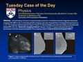 Tuesday Case of the Day History: Clinical history of known invasive ductal carcinoma. Contrast-enhanced magnetic resonance imaging (CE-MRI) is the current.