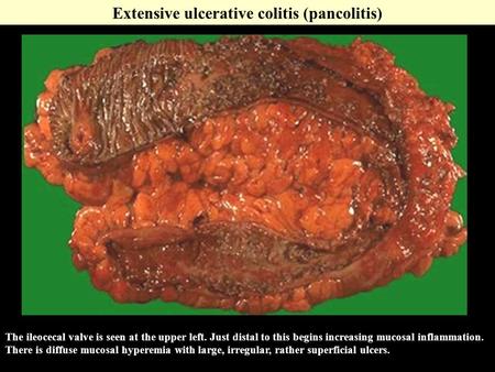 The ileocecal valve is seen at the upper left. Just distal to this begins increasing mucosal inflammation. There is diffuse mucosal hyperemia with large,