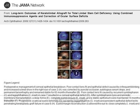 Date of download: 6/1/2016 Copyright © 2016 American Medical Association. All rights reserved. From: Long-term Outcomes of Keratolimbal Allograft for Total.