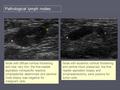 Pathological lymph nodes: